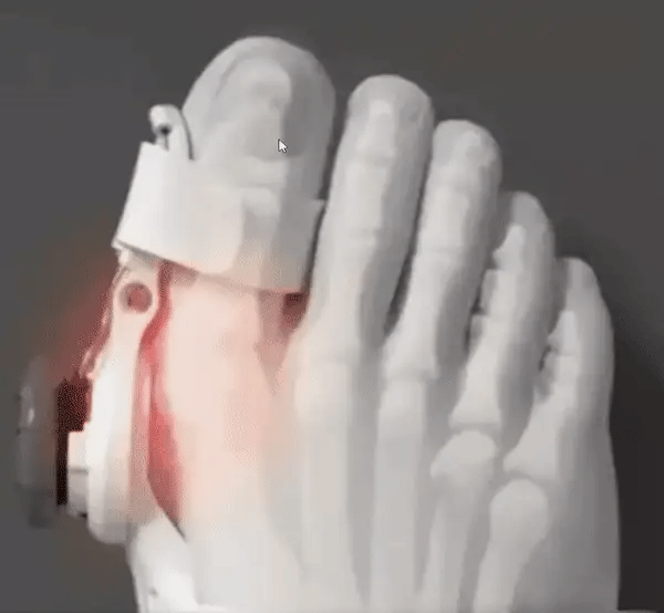 Lavfix Halluks Valgus Düzenleyici